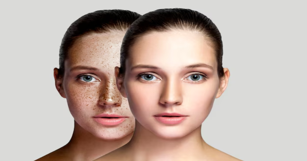 Tretinoin Before and After