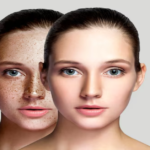 Tretinoin Before and After